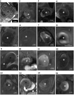 Correlation Between Thrombus Signal Intensity and Aneurysm Wall Thickness in Partially Thrombosed Intracranial Aneurysms Using 7T Magnetization-Prepared Rapid Acquisition Gradient Echo Magnetic Resonance Imaging